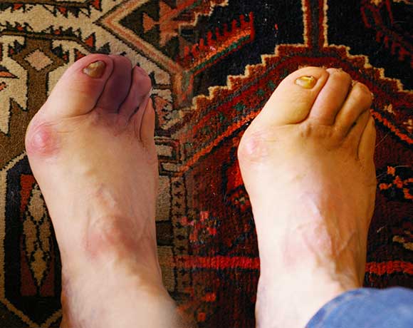 A comparison of Leon's foot when he was diagnosed as diabetic versus what his foot looks like today as a result of a healthy lifestyle